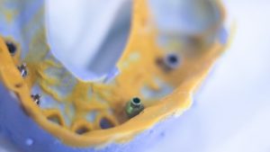 Afbeelding van cursus Suprastructuren op implantaten