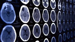 Afbeelding van cursus Neurologische problematiek in de palliatieve fase