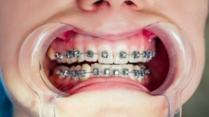 Afbeelding van cursus Orthodontie: indicatie en timing
