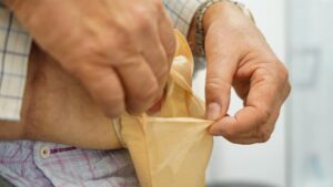 Afbeelding van cursus Stomaspoelen en stomazorg