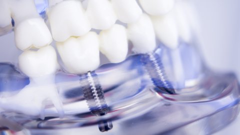 Afbeelding van cursus Peri-implantaire aandoeningen: oorzaken en behandeling