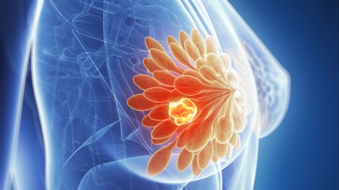 Cursus Fit na kanker: revalidatie na de behandeling van borstkanker Afbeelding van cursus Fit na kanker: revalidatie na de behandeling van borstkanker