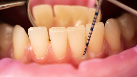 Afbeelding van cursus Parodontale diagnostiek